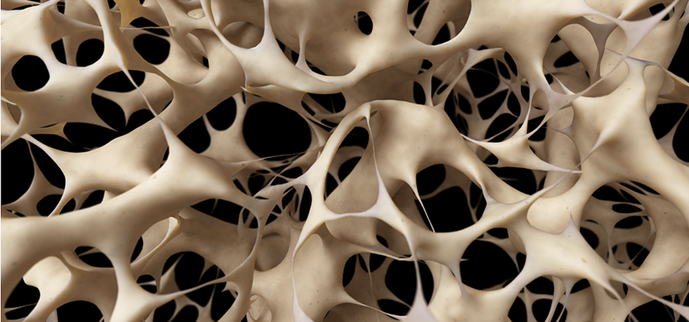 Osteoporóza - článok